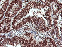 IHC of paraffin-embedded Adenocarcinoma of Human endometrium tissue using anti-TRIM38 mouse monoclonal antibody.