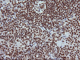 IHC of paraffin-embedded Human lymphoma tissue using anti-TRIM38 mouse monoclonal antibody.