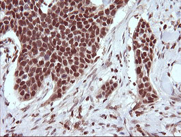 IHC of paraffin-embedded Carcinoma of Human bladder tissue using anti-TRIM38 mouse monoclonal antibody.