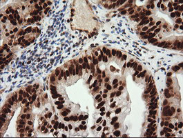 IHC of paraffin-embedded Adenocarcinoma of Human ovary tissue using anti-TRIM38 mouse monoclonal antibody.
