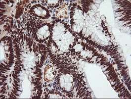 IHC of paraffin-embedded Adenocarcinoma of Human colon tissue using anti-TRIM38 mouse monoclonal antibody.