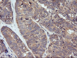 IHC of paraffin-embedded Adenocarcinoma of Human ovary tissue using anti-TRIM38 mouse monoclonal antibody.