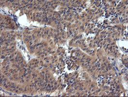 IHC of paraffin-embedded Carcinoma of Human thyroid tissue using anti-TRIM38 mouse monoclonal antibody.