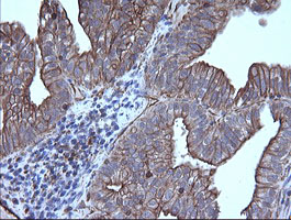 IHC of paraffin-embedded Adenocarcinoma of Human ovary tissue using anti-TRIM38 mouse monoclonal antibody.