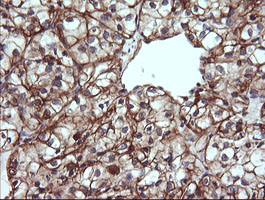 IHC of paraffin-embedded Carcinoma of Human kidney tissue using anti-TRIM38 mouse monoclonal antibody.