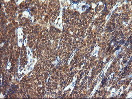 IHC of paraffin-embedded Human lymphoma tissue using anti-TRIM44 mouse monoclonal antibody.