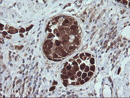 IHC of paraffin-embedded Carcinoma of Human bladder tissue using anti-TRIM44 mouse monoclonal antibody.