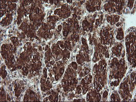 IHC of paraffin-embedded Carcinoma of Human liver tissue using anti-TRIM44 mouse monoclonal antibody.