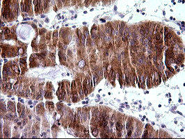 IHC of paraffin-embedded Carcinoma of Human pancreas tissue using anti-TRIM45 mouse monoclonal antibody. (Heat-induced epitope retrieval by 10mM citric buffer, pH6.0, 120°C for 3min).
