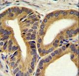 TRIM65 Antibody immunohistochemistry of formalin-fixed and paraffin-embedded human prostate carcinoma followed by peroxidase-conjugated secondary antibody and DAB staining.