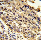 Formalin-fixed and paraffin-embedded human lung carcinoma reacted with TRIP13 Antibody , which was peroxidase-conjugated to the secondary antibody, followed by DAB staining. This data demonstrates the use of this antibody for immunohistochemistry; clinical relevance has not been evaluated.