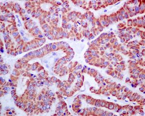 IHC of paraffin-embedded human thyroid carcinoma tissue using anti-TRMT1 antibody.