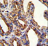 Formalin-fixed and paraffin-embedded human prostate carcinoma with TROP2 Antibody , which was peroxidase-conjugated to the secondary antibody, followed by DAB staining. This data demonstrates the use of this antibody for immunohistochemistry; clinical relevance has not been evaluated.