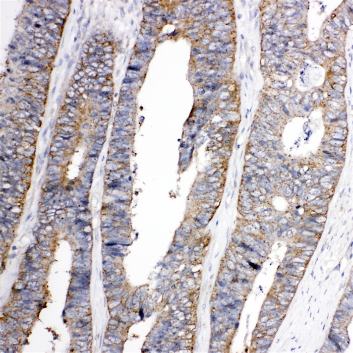 TRPC3 antibody. IHC(P): Human Rectal Cancer Tissue.