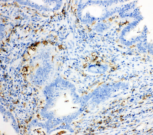 TRPC6 antibody. IHC(P): Human Intestinal Cancer Tissue.