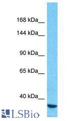TRPM3 antibody Western Blot of Stomach Tumor. Antibody dilution: 1 ug/ml.