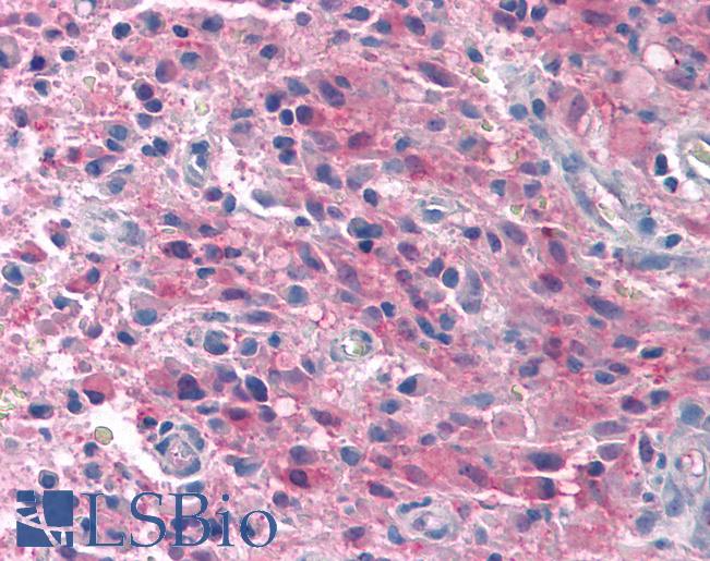 Anti-TRPM4 antibody IHC of human Brain, Glioblastoma. Immunohistochemistry of formalin-fixed, paraffin-embedded tissue after heat-induced antigen retrieval.