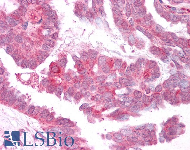 Anti-TRPM4 antibody IHC of human Ovary, Carcinoma. Immunohistochemistry of formalin-fixed, paraffin-embedded tissue after heat-induced antigen retrieval.