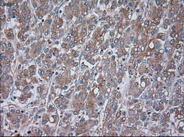 IHC of paraffin-embedded Carcinoma of liver tissue using anti-TRPM4 mouse monoclonal antibody. (Dilution 1:50).