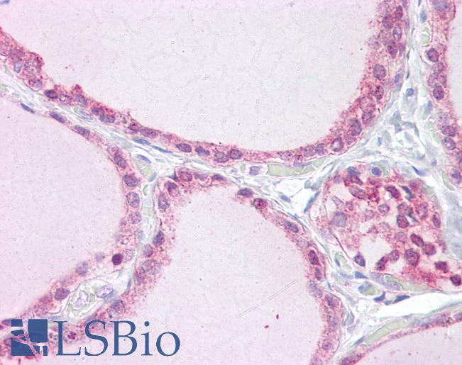 Anti-TRPM7 antibody IHC of human thyroid. Immunohistochemistry of formalin-fixed, paraffin-embedded tissue after heat-induced antigen retrieval. Antibody LS-B6929 concentration 10 ug/ml.