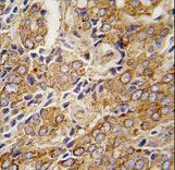 Formalin-fixed and paraffin-embedded human prostate carcinoma tissue reacted with TRPM8 antibody (C-term C940) , which was peroxidase-conjugated to the secondary antibody, followed by DAB staining. This data demonstrates the use of this antibody for immunohistochemistry; clinical relevance has not been evaluated.