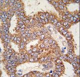 Formalin-fixed and paraffin-embedded human prostate carcinoma tissue reacted with TRPM8 antibody , which was peroxidase-conjugated to the secondary antibody, followed by DAB staining. This data demonstrates the use of this antibody for immunohistochemistry; clinical relevance has not been evaluated.
