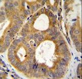 TRPM8 Antibody immunohistochemistry of formalin-fixed and paraffin-embedded human prostate carcinoma followed by peroxidase-conjugated secondary antibody and DAB staining.