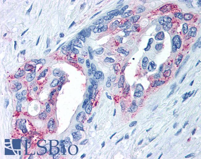 Anti-TRPM8 antibody IHC of human Pancreas, Carcinoma. Immunohistochemistry of formalin-fixed, paraffin-embedded tissue after heat-induced antigen retrieval.