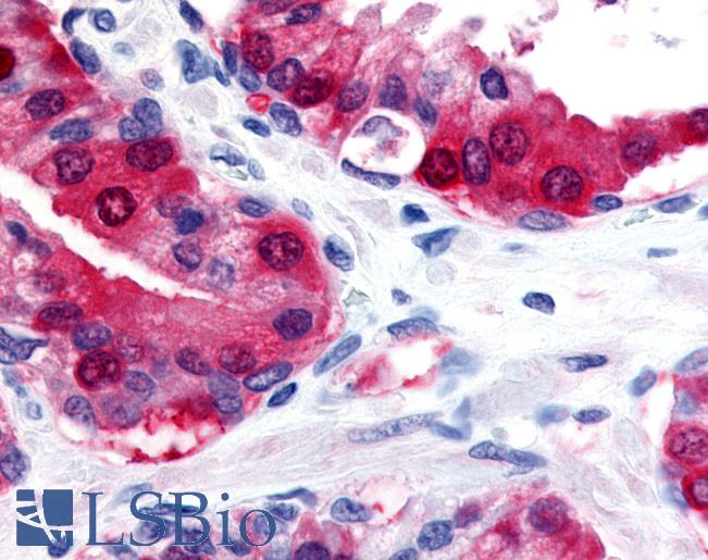 Anti-TRPM8 antibody LS-A8090 IHC of human prostate. Immunohistochemistry of formalin-fixed, paraffin-embedded tissue after heat-induced antigen retrieval.