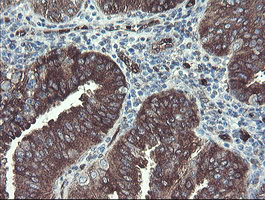 IHC of paraffin-embedded Adenocarcinoma of Human endometrium tissue using anti-TSC22D1 mouse monoclonal antibody.