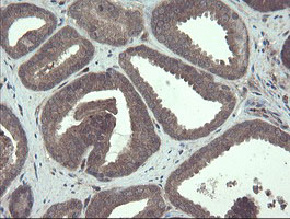 IHC of paraffin-embedded Carcinoma of Human prostate tissue using anti-TSC22D1 mouse monoclonal antibody.