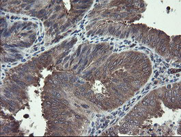 IHC of paraffin-embedded Adenocarcinoma of Human endometrium tissue using anti-TSC22D1 mouse monoclonal antibody.