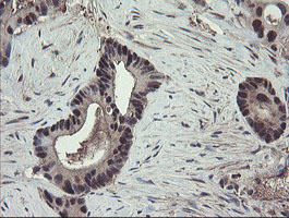IHC of paraffin-embedded Adenocarcinoma of Human colon tissue using anti-TSC22D1 mouse monoclonal antibody.