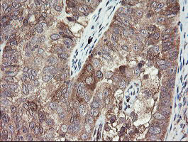 IHC of paraffin-embedded Adenocarcinoma of Human ovary tissue using anti-TSC22D1 mouse monoclonal antibody.