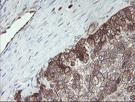 IHC of paraffin-embedded Adenocarcinoma of Human ovary tissue using anti-TSC22D1 mouse monoclonal antibody.
