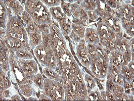 IHC of paraffin-embedded Carcinoma of Human thyroid tissue using anti-TSC22D1 mouse monoclonal antibody.
