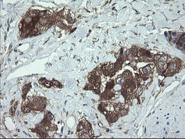 IHC of paraffin-embedded Adenocarcinoma of Human breast tissue using anti-TSC22D1 mouse monoclonal antibody.