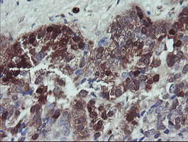 IHC of paraffin-embedded Adenocarcinoma of Human ovary tissue using anti-TSC22D1 mouse monoclonal antibody.