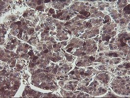 IHC of paraffin-embedded Carcinoma of Human liver tissue using anti-TSC22D1 mouse monoclonal antibody.