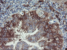 IHC of paraffin-embedded Adenocarcinoma of Human endometrium tissue using anti-TSC22D1 mouse monoclonal antibody.