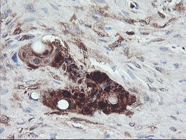 IHC of paraffin-embedded Adenocarcinoma of Human colon tissue using anti-TSC22D1 mouse monoclonal antibody.