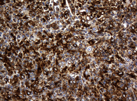 IHC of paraffin-embedded Human lymphoma tissue using anti-TSC22D1 mouse monoclonal antibody.