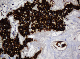 IHC of paraffin-embedded Carcinoma of Human pancreas tissue using anti-TSC22D1 mouse monoclonal antibody.