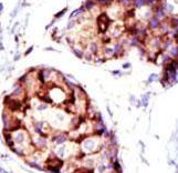 Formalin-fixed and paraffin-embedded human cancer tissue reacted with the primary antibody, which was peroxidase-conjugated to the secondary antibody, followed by AEC staining. This data demonstrates the use of this antibody for immunohistochemistry; clinical relevance has not been evaluated. BC = breast carcinoma; HC = hepatocarcinoma.