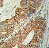 TSPAN3 Antibody immunohistochemistry of formalin-fixed and paraffin-embedded human colon carcinoma followed by peroxidase-conjugated secondary antibody and DAB staining.
