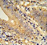 Formalin-fixed and paraffin-embedded human colon carcinoma reacted with TSPAN33 Antibody , which was peroxidase-conjugated to the secondary antibody, followed by DAB staining. This data demonstrates the use of this antibody for immunohistochemistry; clinical relevance has not been evaluated.