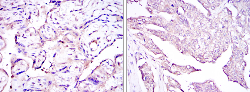 IHC of paraffin-embedded placenta tissues (left) and ovarian cancer (right) using E7 mouse monoclonal antibody with DAB staining.