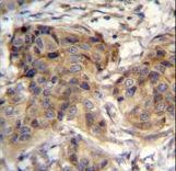 TTC9C Antibody immunohistochemistry of formalin-fixed and paraffin-embedded human breast carcinoma followed by peroxidase-conjugated secondary antibody and DAB staining.