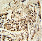 TTPAL Antibody IHC of formalin-fixed and paraffin-embedded human breast carcinoma followed by peroxidase-conjugated secondary antibody and DAB staining.