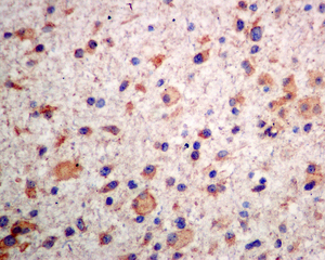 IHC of paraffin-embedded human astrocytoma tissue using anti-TUB antibody.